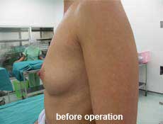 plastic-surgery-breast-augmentation 